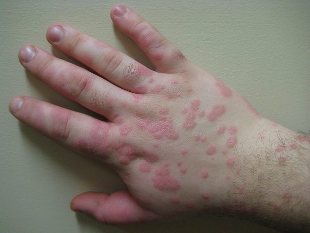 rash on back of hands