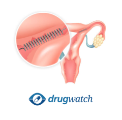 Infographic of Essure Lawsuit Facts: defendant and injuries in lawsuit.