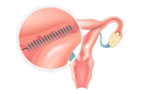 Infographic of Essure Lawsuit Facts: defendant and injuries in lawsuit.