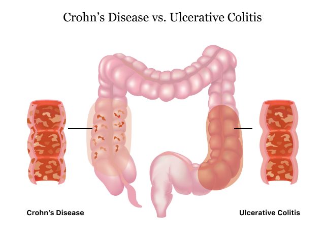 Ulcerative Colitis, UC