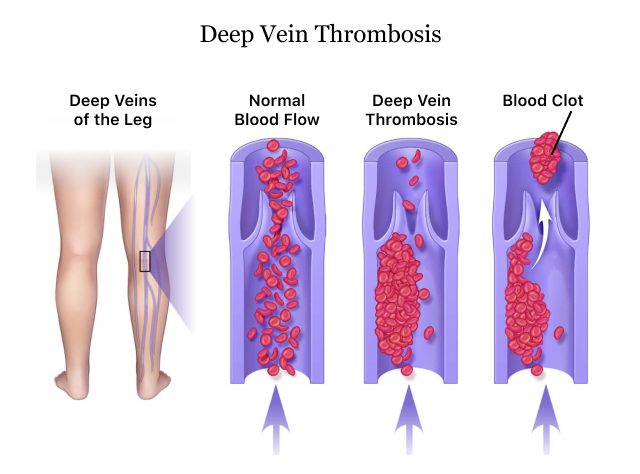 deep vein thrombosis test