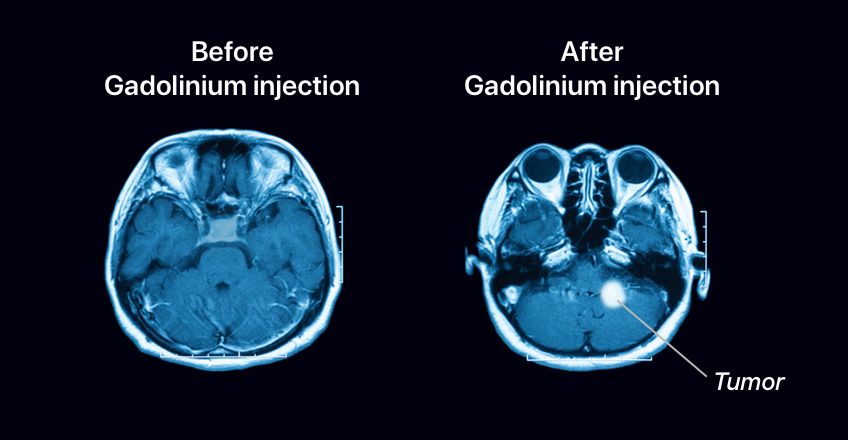 Gadolinium | What Is Gadolinium & What Is It Used for in MRIs?
