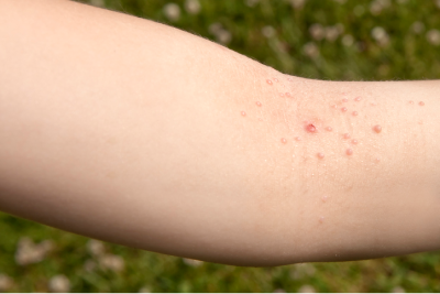 221: Do Rashes In Certain Areas Mean Something?