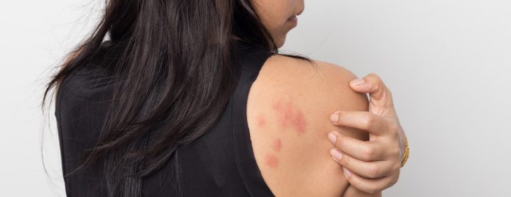 7 Common Skin Rashes Experienced During Travel