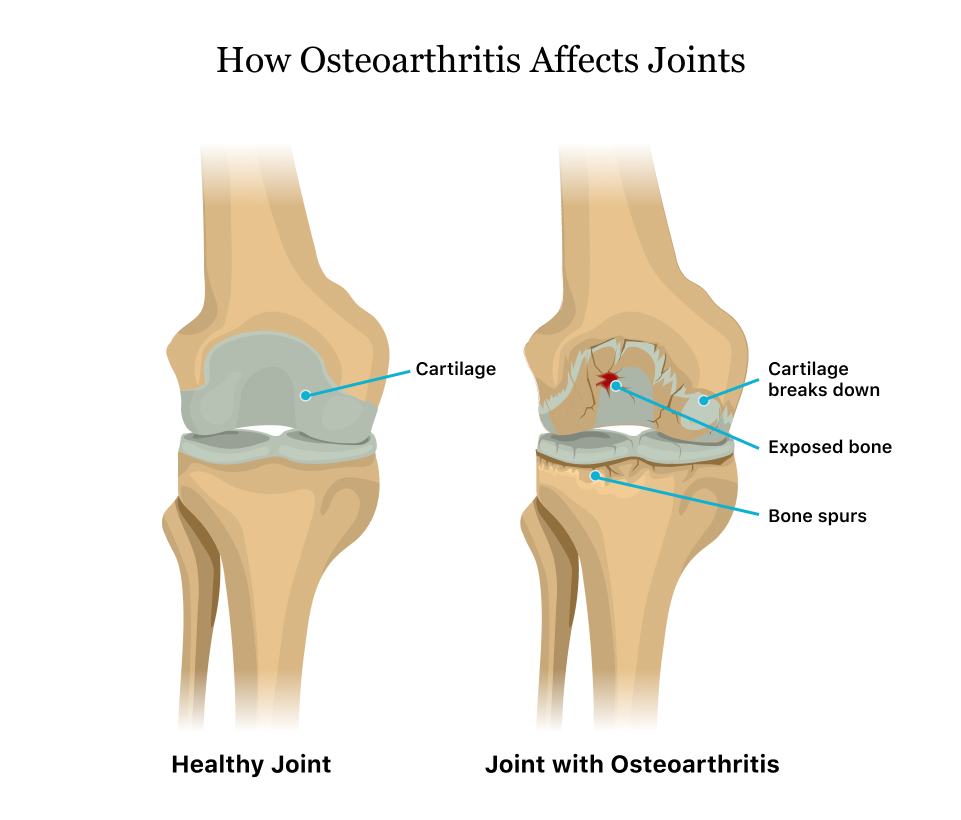 Knee Osteoarthritis, Knee, Health