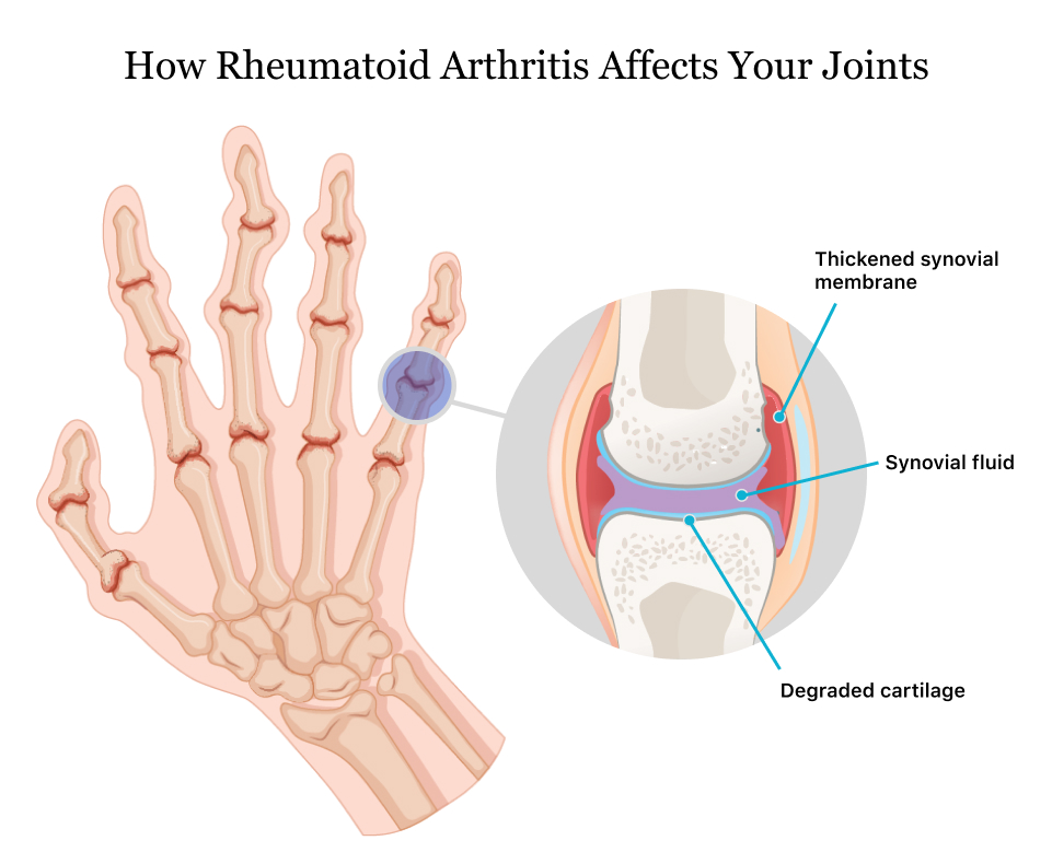 How Rheumatoid Arthritis Affects Your Joints