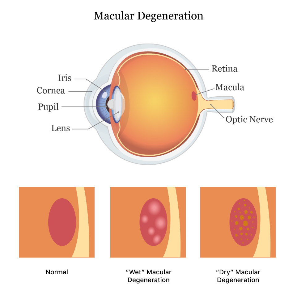 Congenital Disorders that Obscure the Margin of the Optic Disk