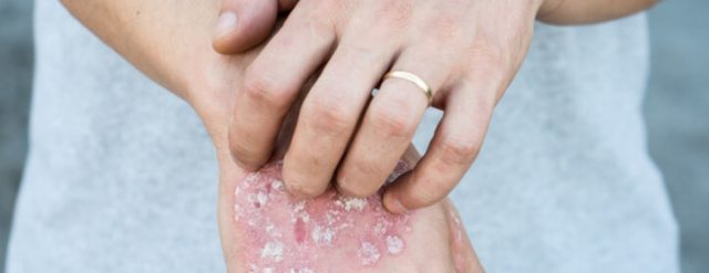 The What, Why, Where And How Of Psoriasis