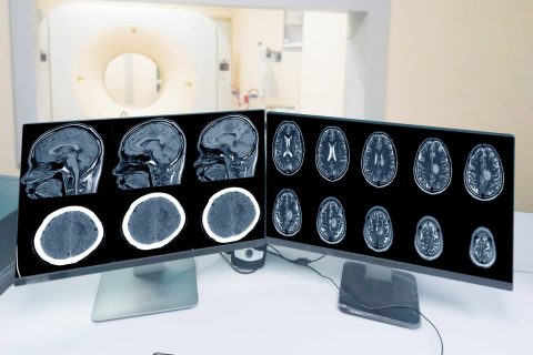 CT-scan control room and showing meningioma