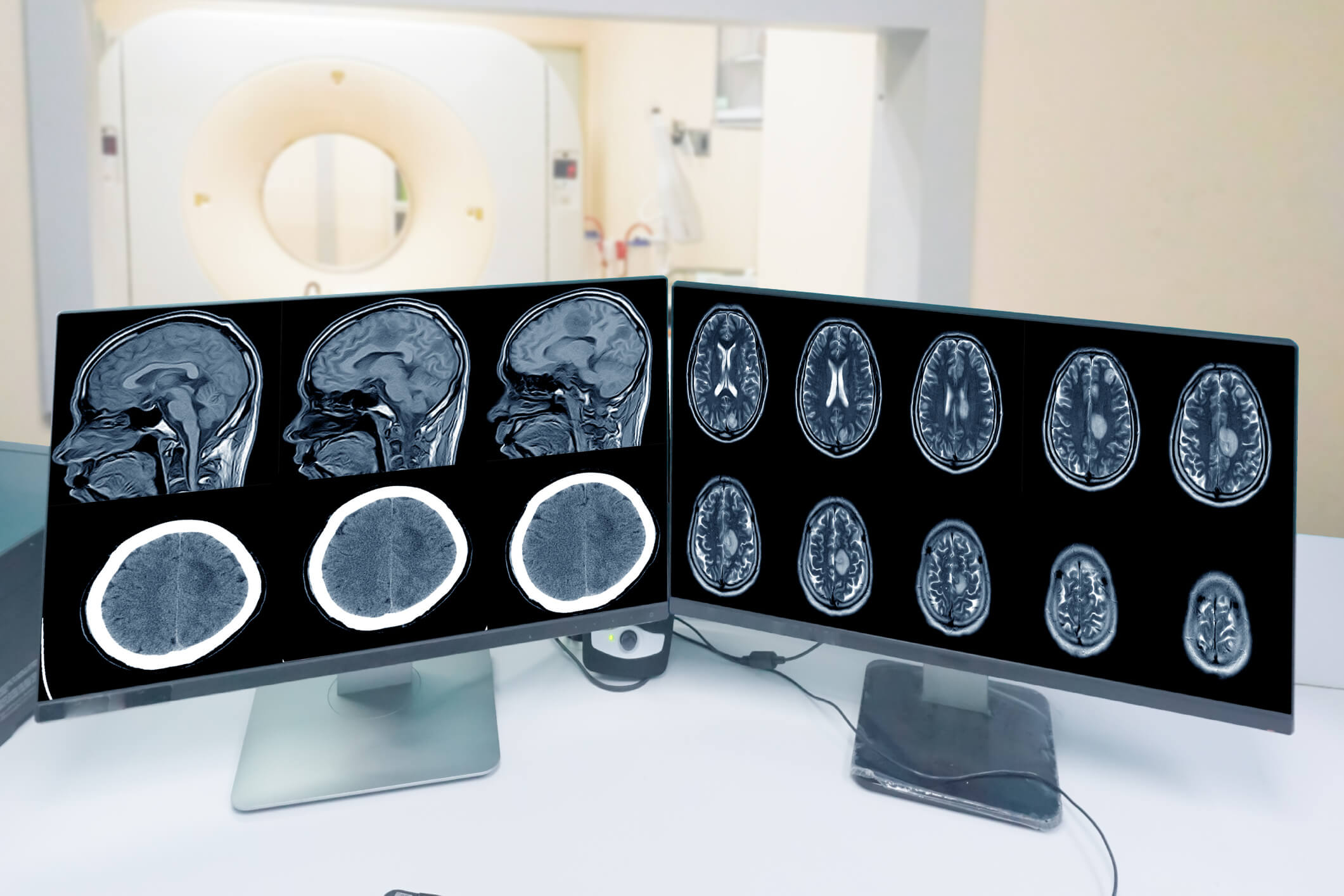 Meningioma Causes: Key Risk Factors And Hormonal Links