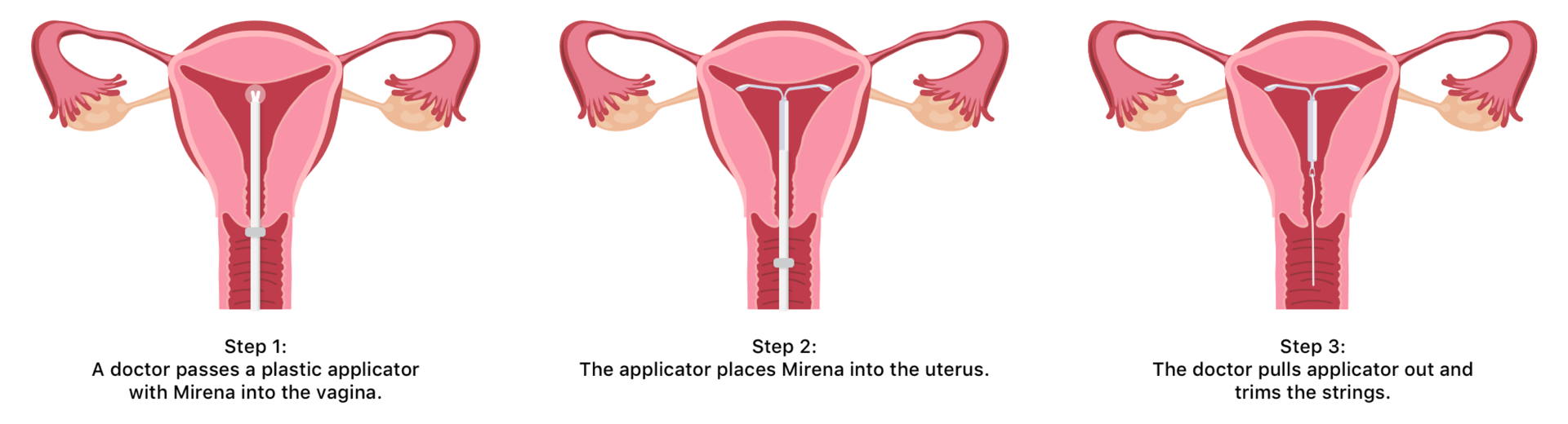 Mirena Insertion What with Mirena IUD Placement
