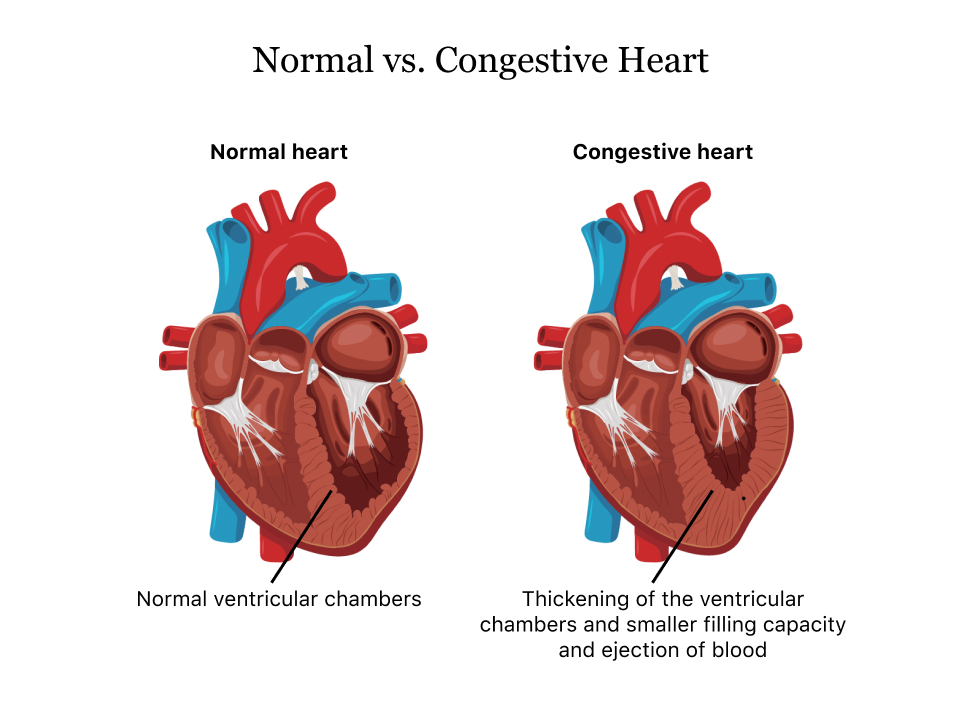 Cardiovascular Model Four Parts Of Human Heart Enlargement Model Za
