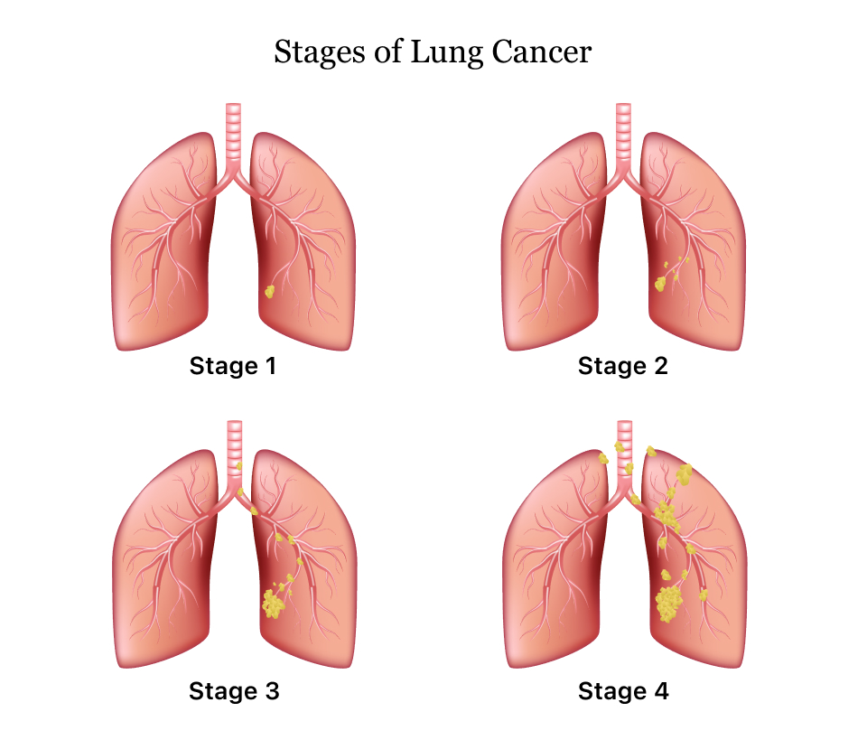 Lung Cancer Symptoms Causes Treatment And Survival Rates
