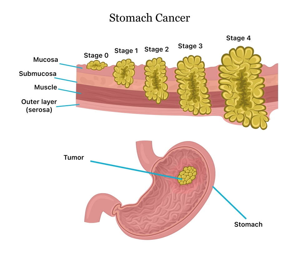 Stomach Cancer | Symptoms, Causes, Stages, Treatment and Survival Rates