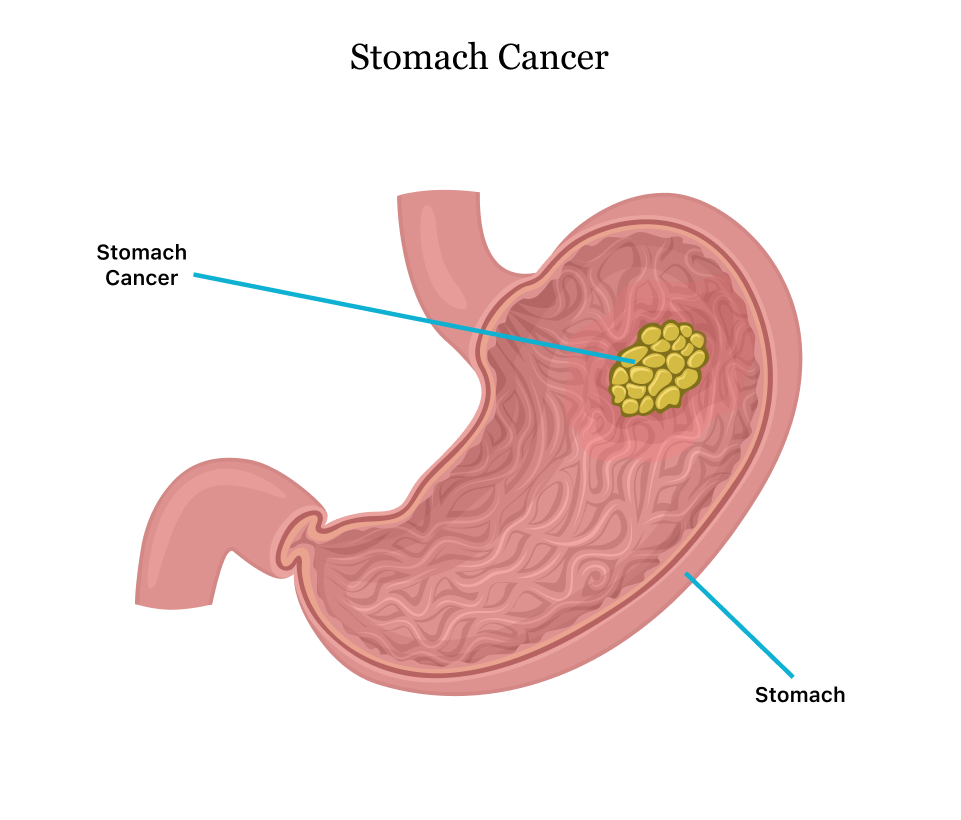 gastric cancer types