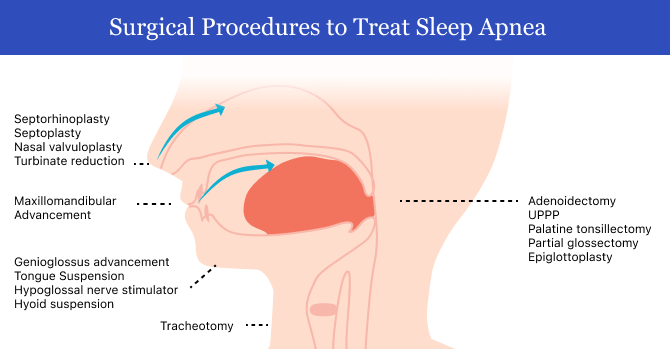 How Can You Treat Obstructive Sleep Apnea?