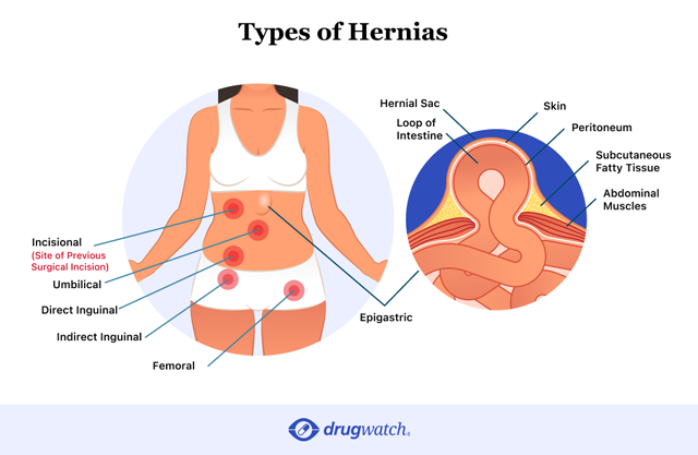 Hernia Types - Umbilical - California Hernia Specialists