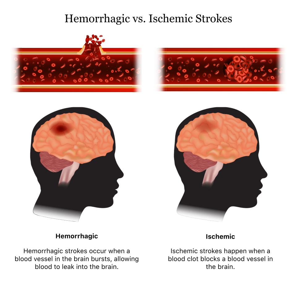 ischemic stroke brain