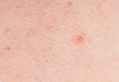 pink dots on skin