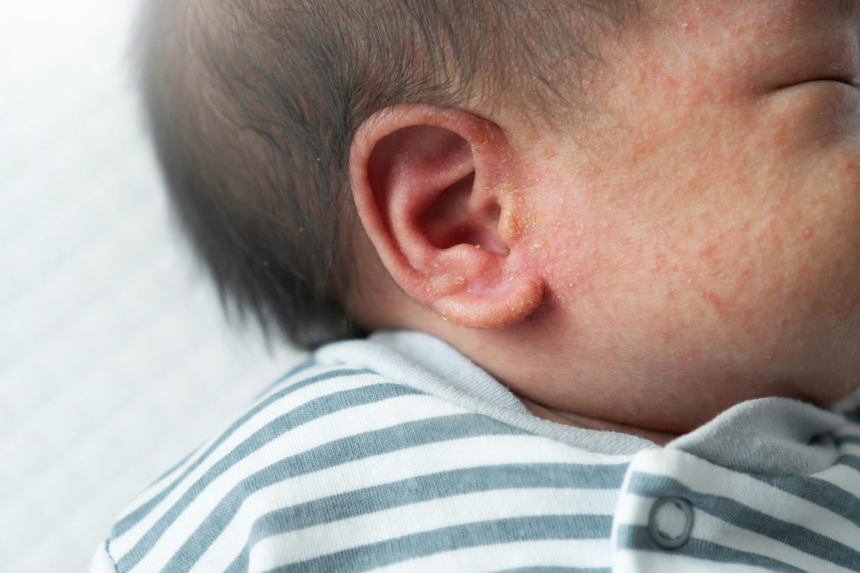 nummular eczema baby