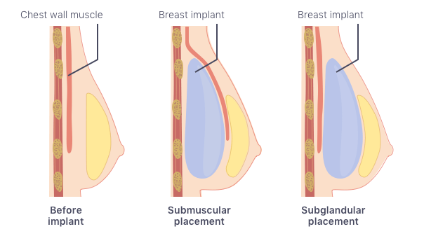 Breast Augmentation, Natrelle® Gummy Implants
