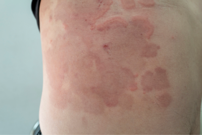 Skin Rashes & Conditions