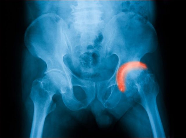 Hip Revision Surgery - Reasons for Surgery & Safety Tips