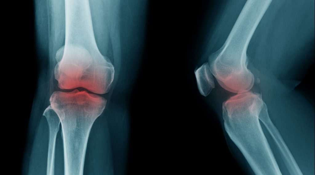 osteoarthritis-symptoms-complications-treatment