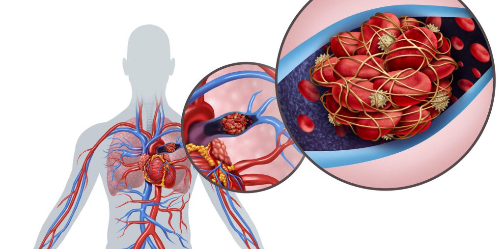 Pulmonary Embolism PE Causes Of A Blood Clot In The Lung