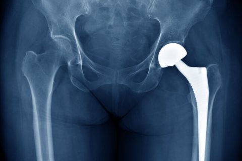 Xray of a hip implant