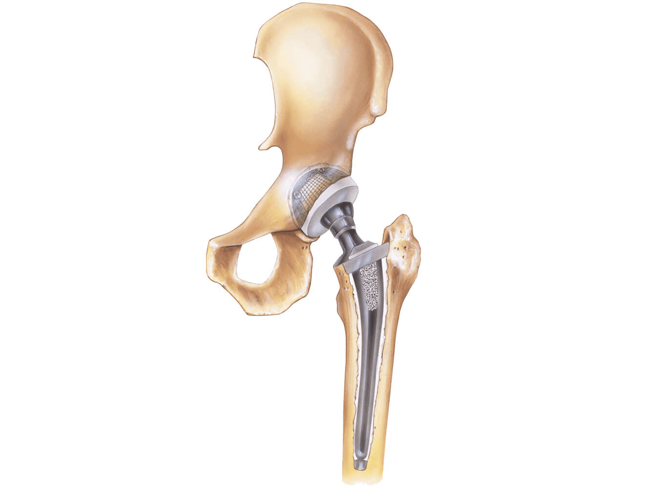 Hip Replacement  Procedure, Symptoms, Types of Implants and Risks