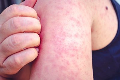 Skin Rashes & Conditions