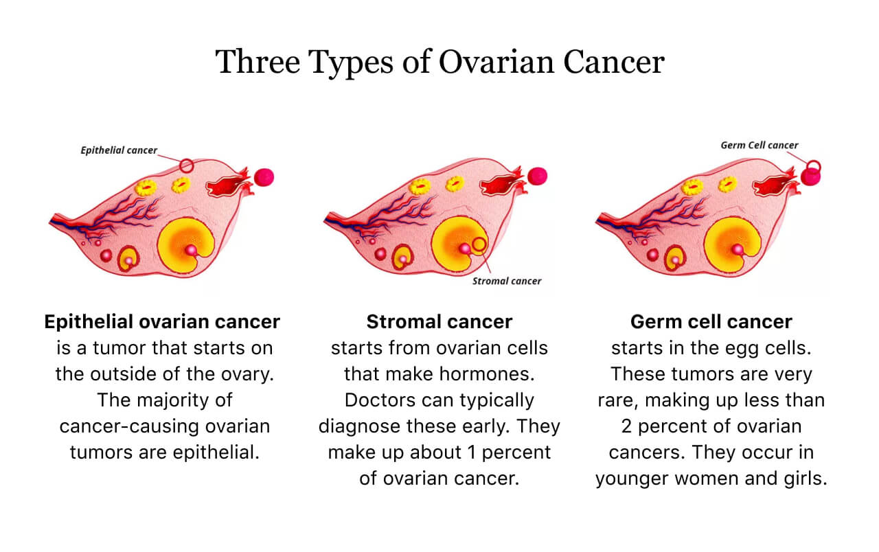 The Stages of Ovarian Cancer and What They Mean