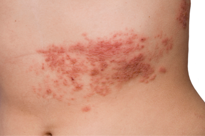 What causes rashes around the groin?