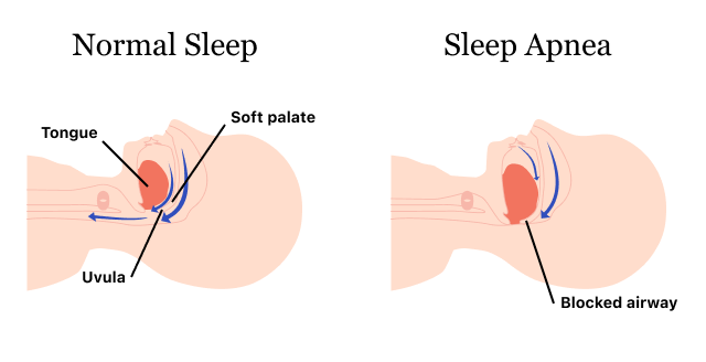 Sleep Apnea  Symptoms, Causes, Diagnosis and Treatment