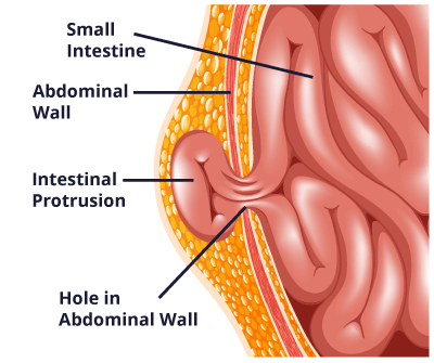 Can a hernia cause you to gain weight