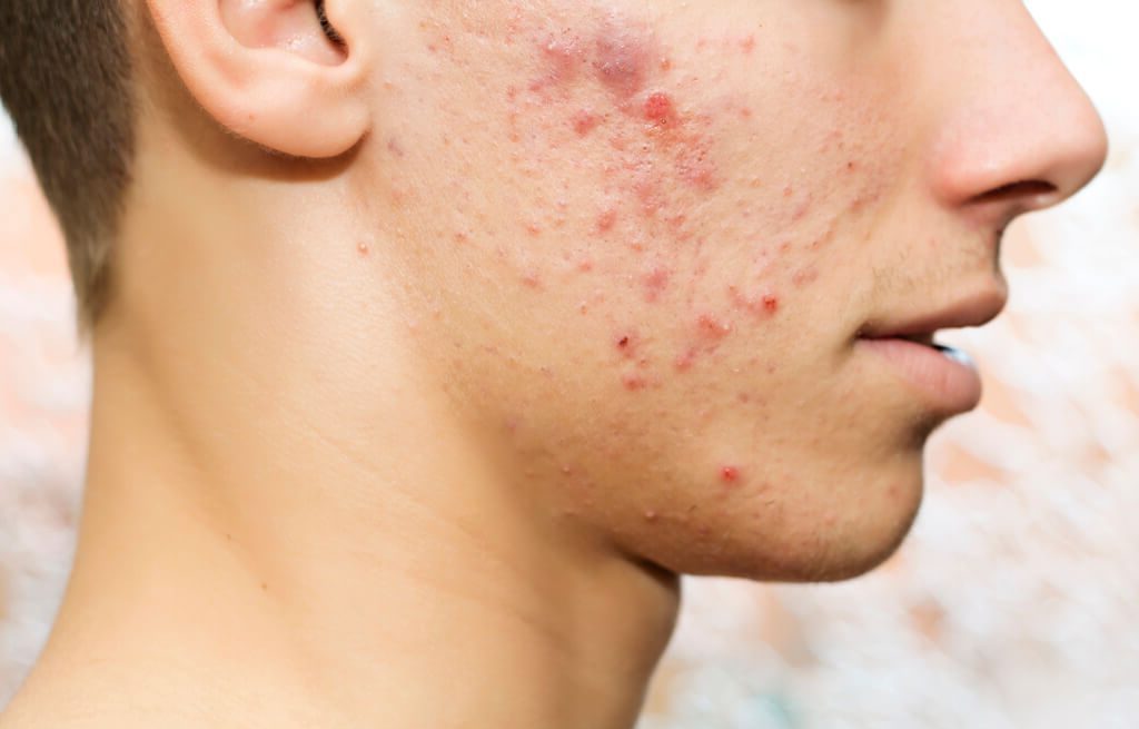 teen-acne-causes-symptoms-treatments-and-prevention