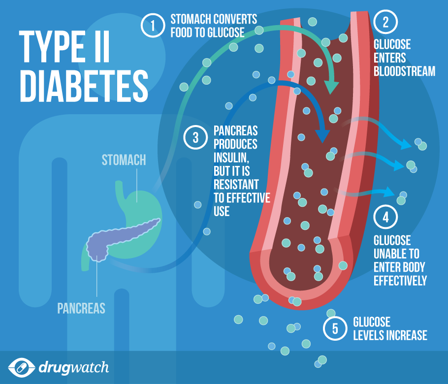research about diabetes type 2