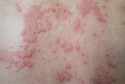 itchy rash all over body